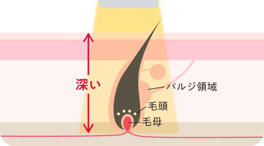 医療脱毛の仕組み