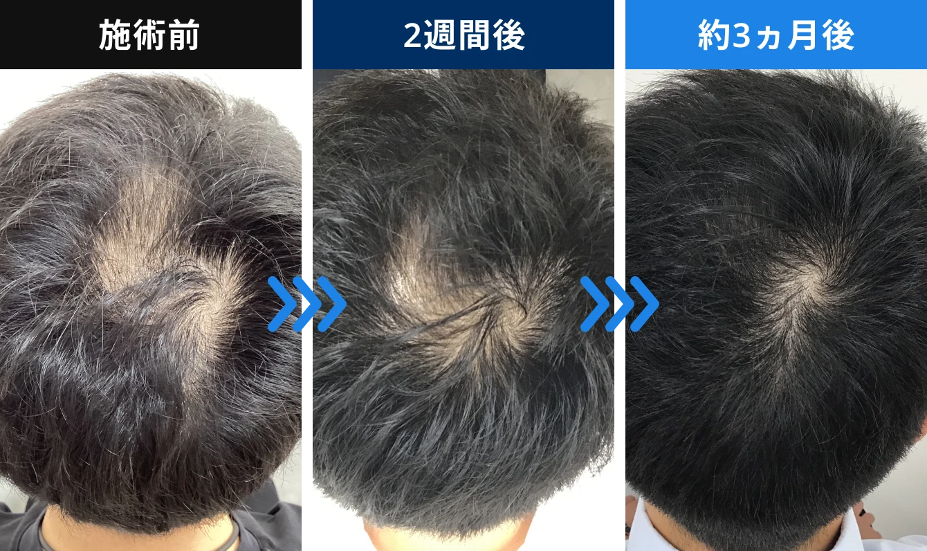はえるん（HAF発毛メソセラピー） 20代 施術部位：頭頂部・生え際の症例