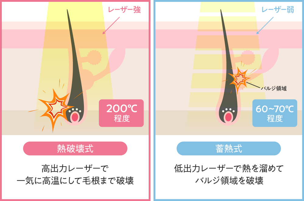 医療脱毛の熱破壊式と蓄熱式のメリット・デメリットは？