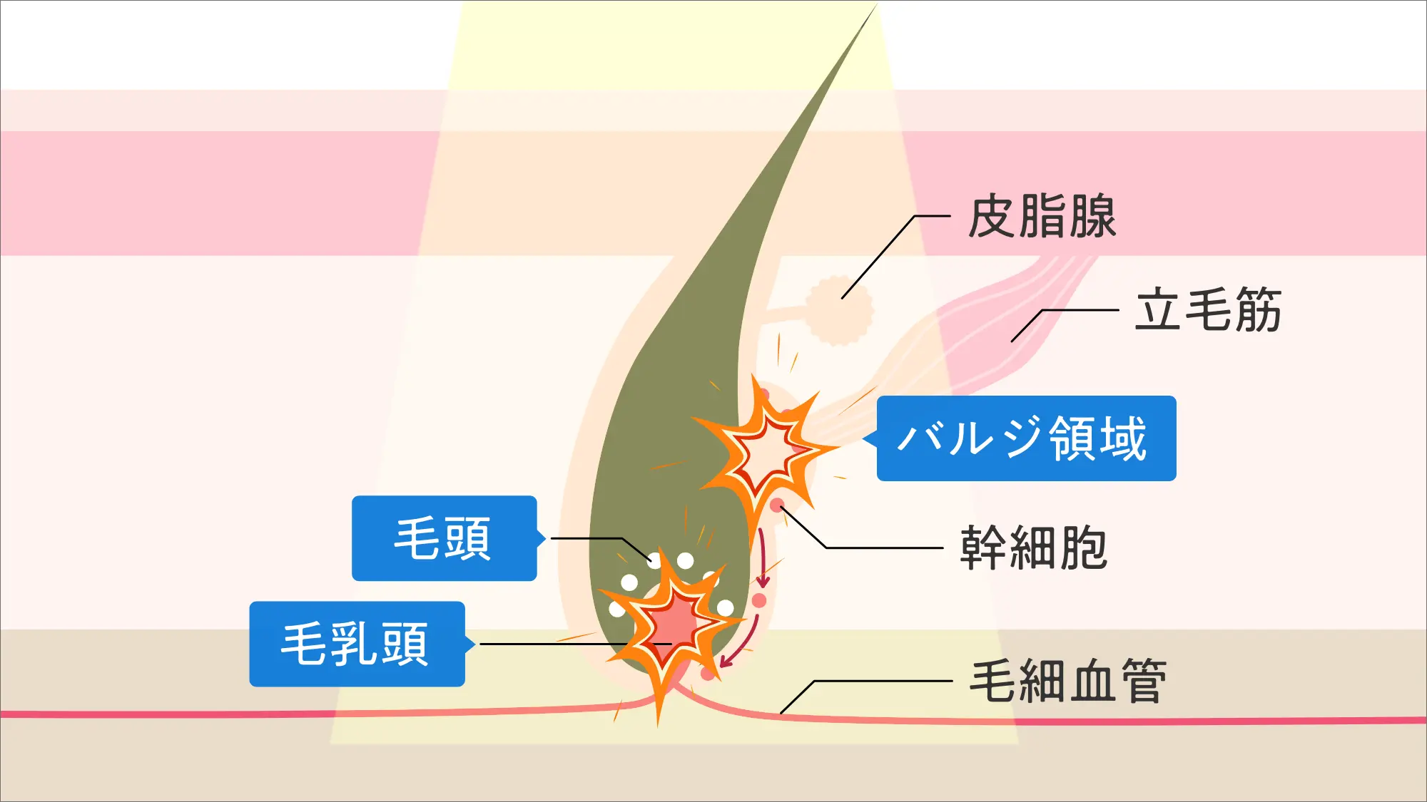 段階2：毛乳頭などの発毛組織を熱の作用で破壊