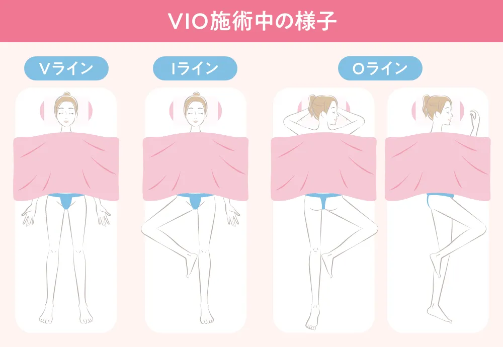 VIO施術中の様子