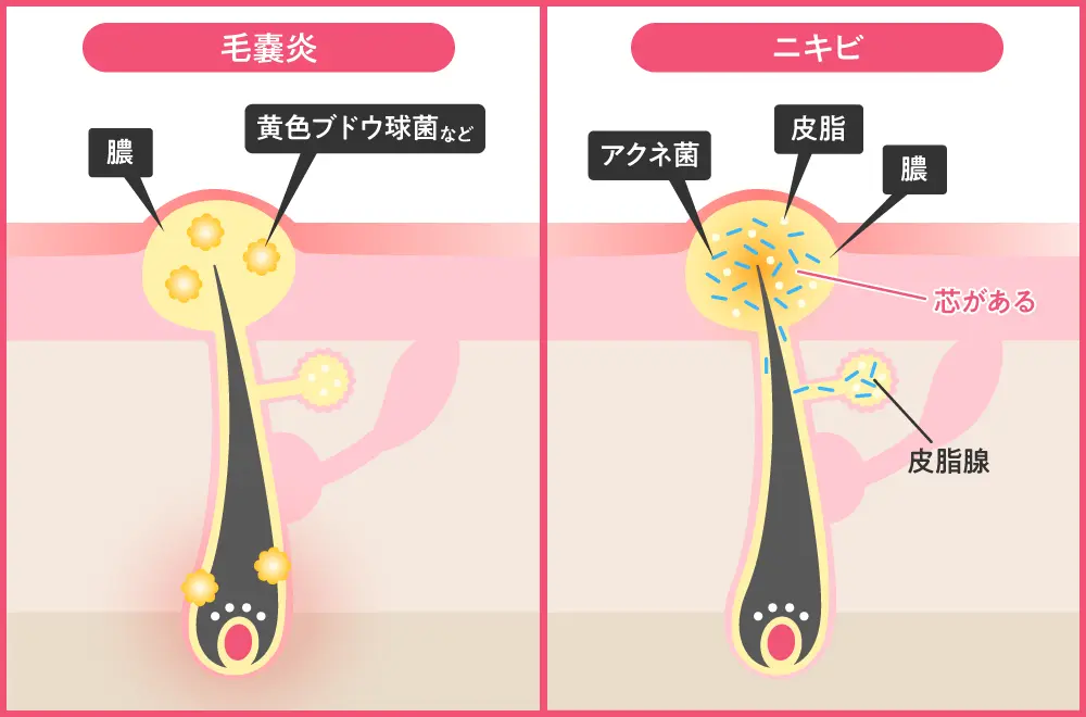 毛嚢炎とニキビの違い