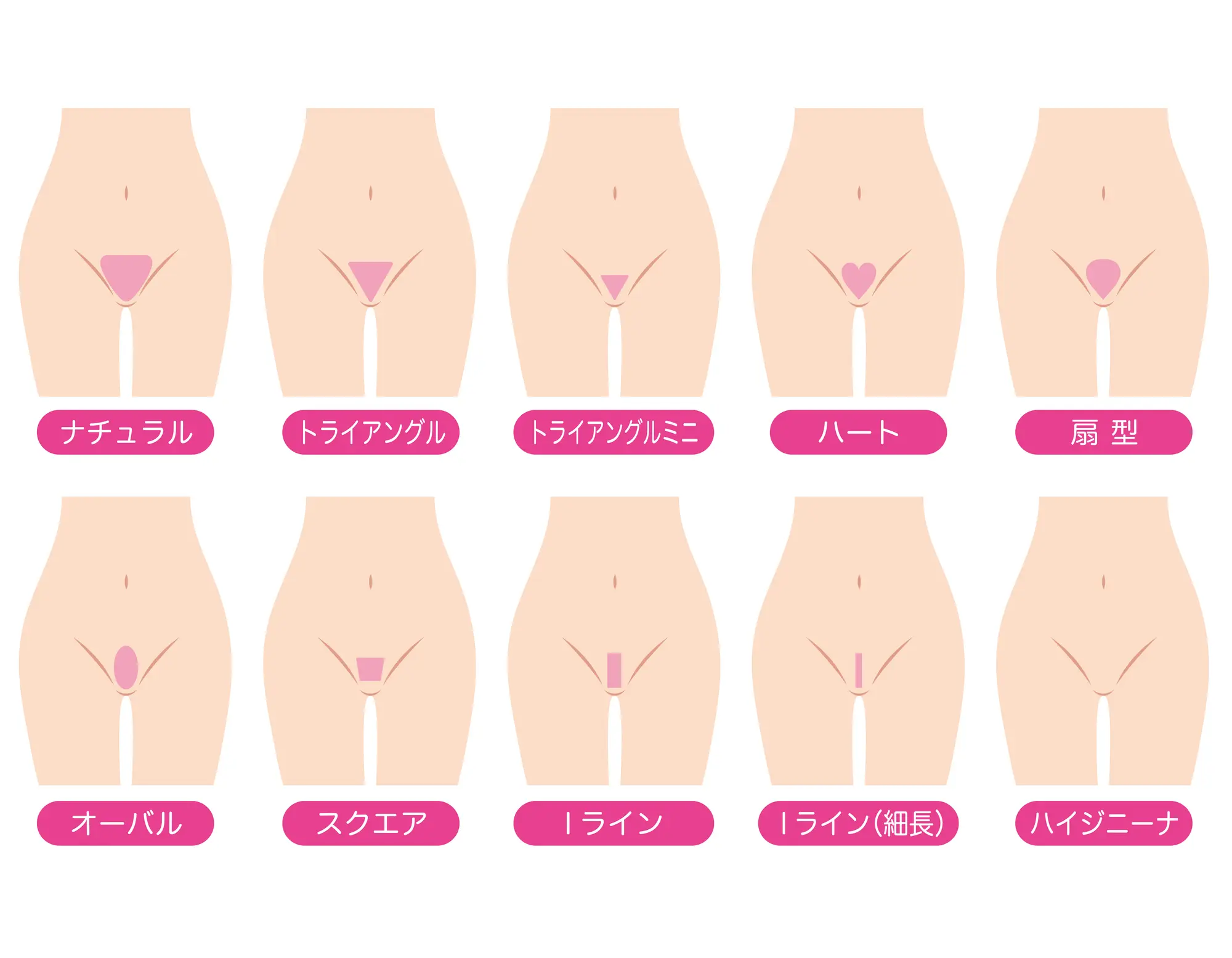 Vラインのデザイン脱毛